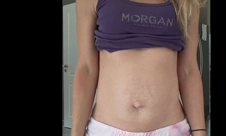 Abdominoplastie et hernie ombilicale - 33395