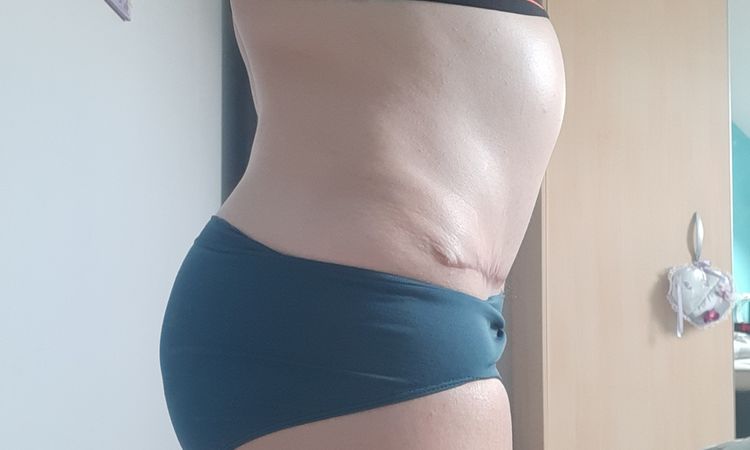 5 mois post op abdominoplastie - 42512