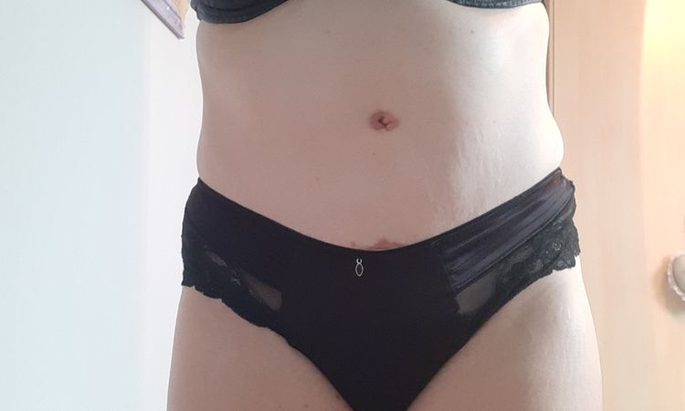5 mois post op abdominoplastie - 42513