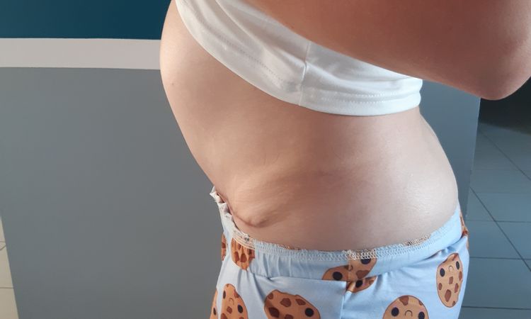 5 mois post op abdominoplastie - 42514