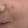 Traitement d’un point rouge vascularisé sur le visage d’une fillette de 9 ans - 43644