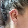 Cheloide piercing oreille