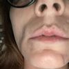 Cicatrices lèvres suite à un lupus