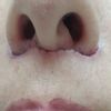 Berges écartés après liplift