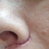 Berges écartés après liplift