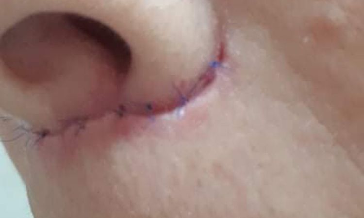 Berges écartés après liplift - 45050