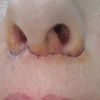Berges écartés après liplift
