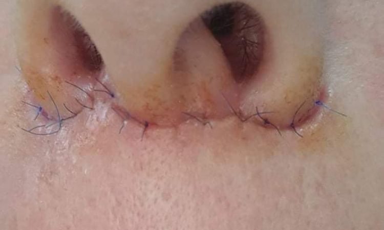 Berges écartés après liplift - 45051