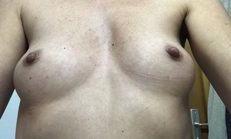 Augmentation mammaire et reprise cicatrice laparotomie - 46263