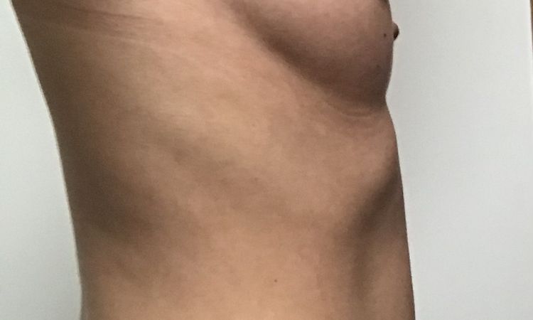 Augmentation mammaire et reprise cicatrice laparotomie - 46264