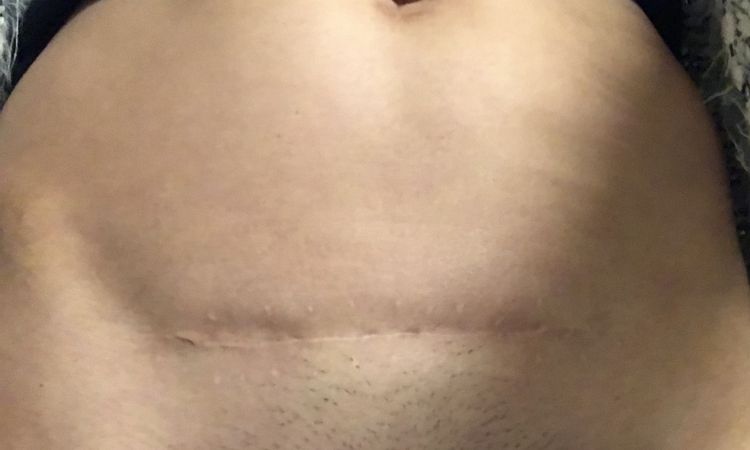 Augmentation mammaire et reprise cicatrice laparotomie - 46265