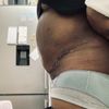 Cure de diastasis pour reprise abdominoplastie