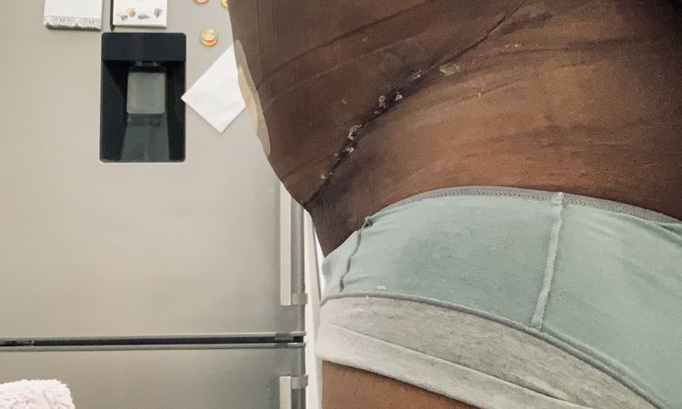 Cure de diastasis pour reprise abdominoplastie - 46367
