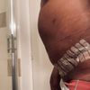 Cure de diastasis pour reprise abdominoplastie