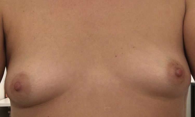 Des seins trop petits : une malformation ? - 47710