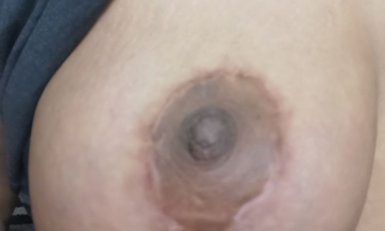 Des cicatrices brunes après une mastopexie - 47793