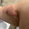Vergetures enflammées après plasma lift