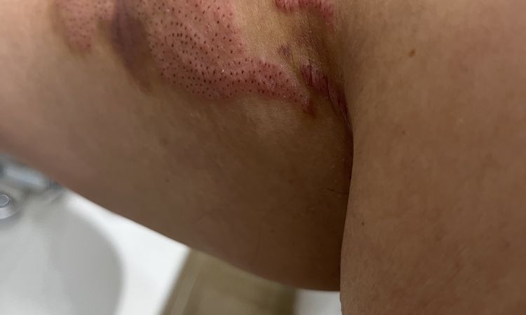 Vergetures enflammées après plasma lift - 47999