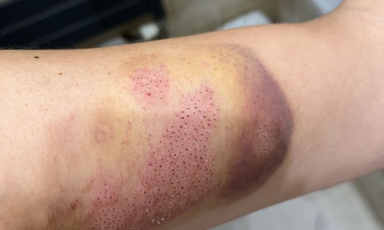 Vergetures enflammées après plasma lift - 48000