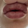 Des boules après injections d'AH dans les lèvres