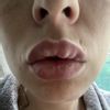 Des boules après injections d'AH dans les lèvres