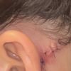 Cicatrice rouge et boursouflée derrière l’oreille - 50324