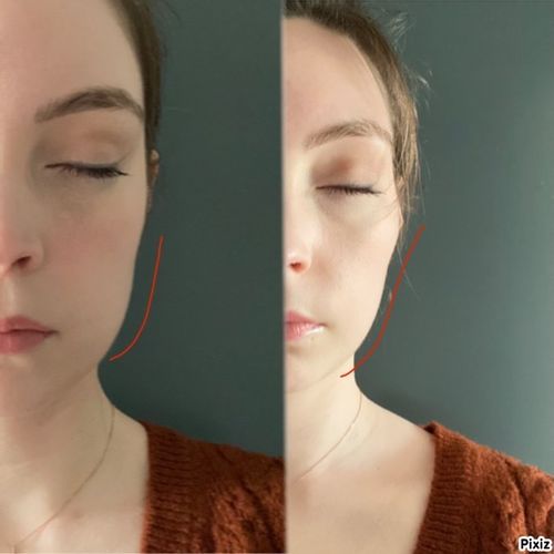 Asymétrie joue/maâhoire