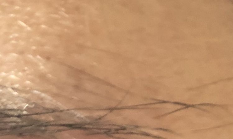 Un spécialiste pour reboucher un trou de piercing ? - 50901