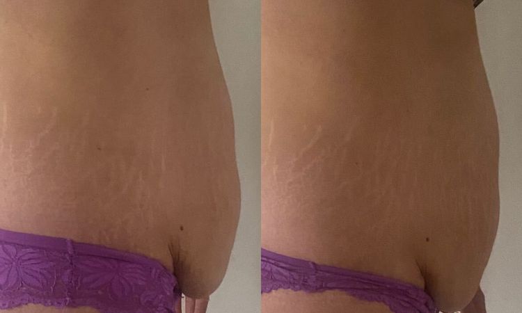 Abdominoplastie et prise en charge - 51034
