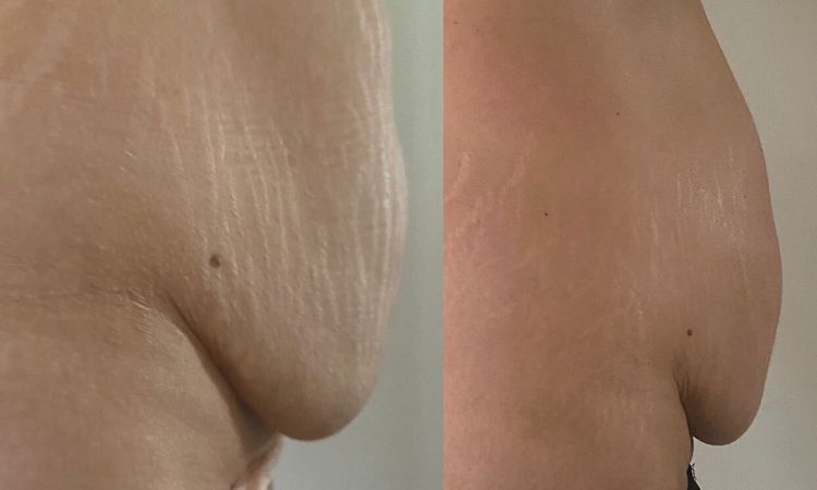 Abdominoplastie et prise en charge - 51035