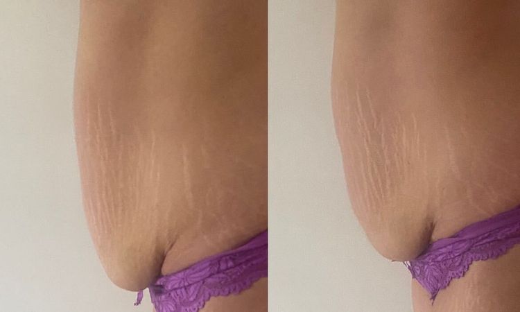 Abdominoplastie et prise en charge - 51036