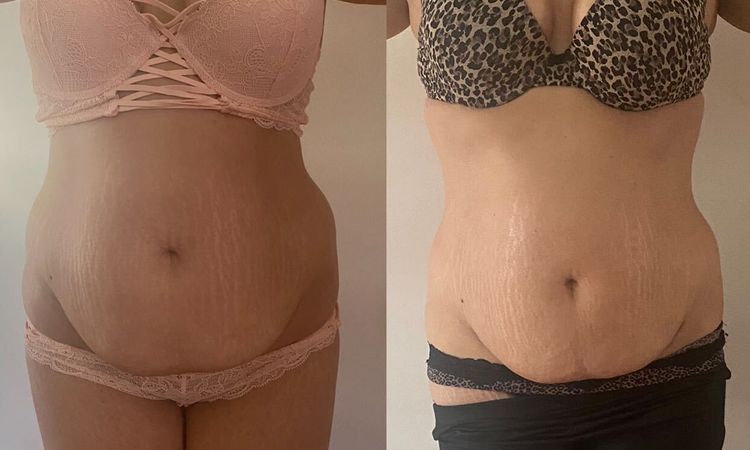 Abdominoplastie et prise en charge - 51037