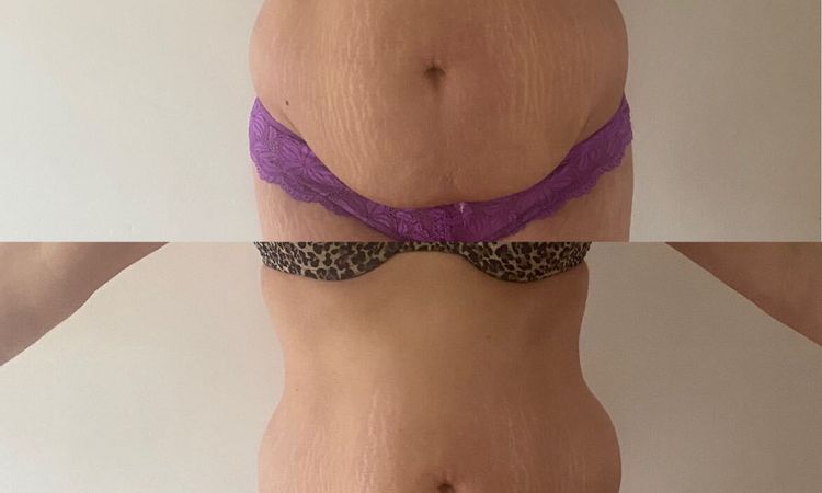 Abdominoplastie et prise en charge - 51038