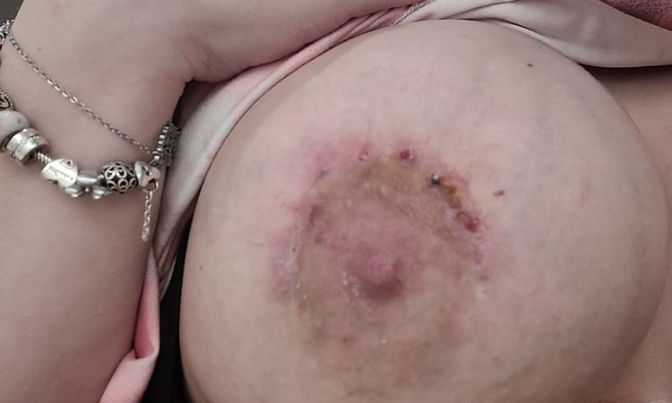 Problème de fils résorbables - 52866