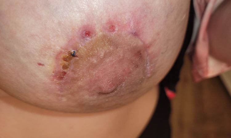 Problème de fils résorbables - 52867