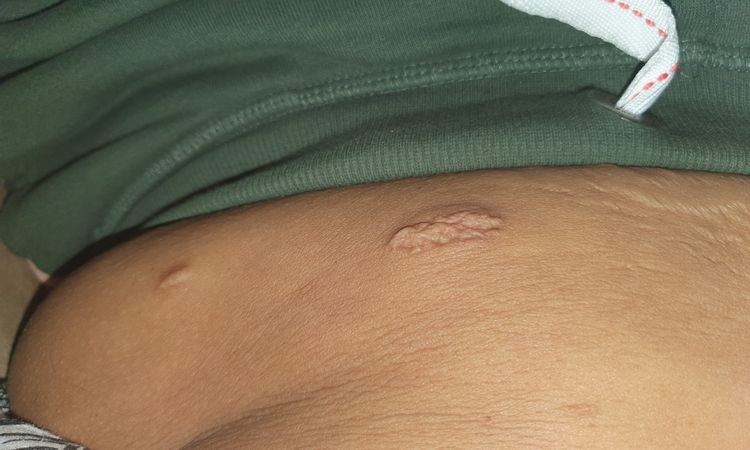 Reprise de cicatrices après sleeve et abdominoplastie - 53471