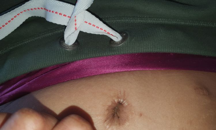 Reprise de cicatrices après sleeve et abdominoplastie - 53472