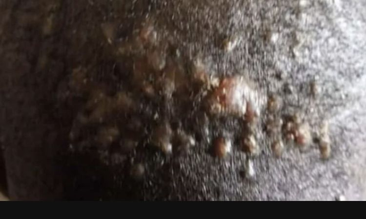 Chéloïdes derrière la nuque : quel traitement ? - 54233