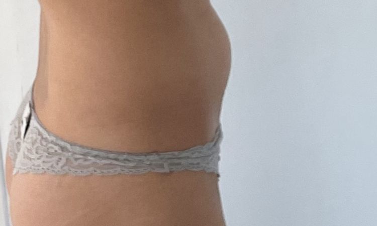 Abdominoplastie et SCI - 54500