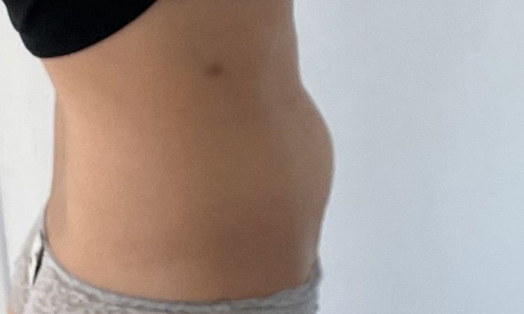 Abdominoplastie et SCI - 54501