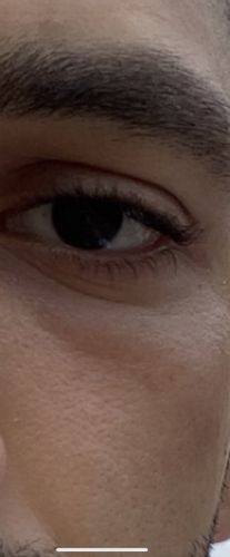 Déshydratation et rougeurs suite à une brûlure : que faire ?