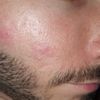 Peeling, peeling profond ou injection pour traiter des marques sur le visage ?