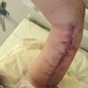 Les cicatrices d'un lifting des bras
