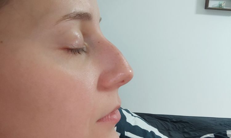 Lèvre endormie 5 mois après une rhinoplastie - 56851