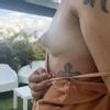 Augmentation mammaire et aréoles protruses