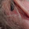 Cicatrices enflées et boutons après mini lift