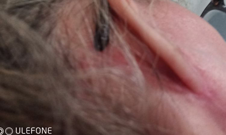 Cicatrices enflées et boutons après mini lift - 57555