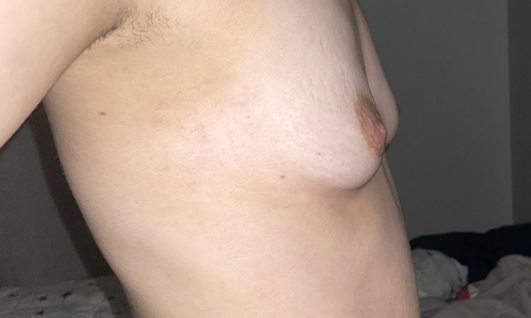 Augmentation mammaire et PEC Cpam - 57856