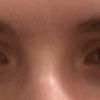 Œdème lymphatique suite brûlure au retinal contour de l’œil : que faire ? - 58483