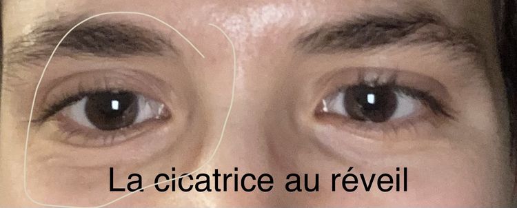 Œdème lymphatique suite brûlure au retinal contour de l’œil : que faire ...